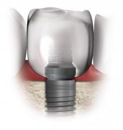 Implantology